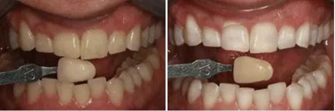 A before and after picture of a person 's teeth.