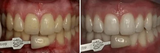 A before and after picture of a person 's teeth.