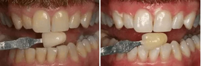 A before and after picture of a person 's teeth.