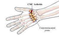 Kleiser Therapy Treats CMC Arthritis