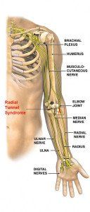 Kleiser Therapy Treats Radial Tunnel Syndrome