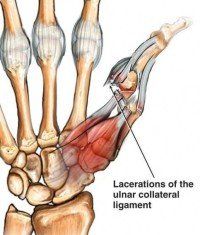 Kleiser Therapy Treats Ulnar Collateral Ligament Issues