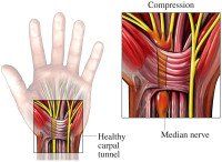 Kleiser Therapy Treats Carpal Tunnel Syndrome