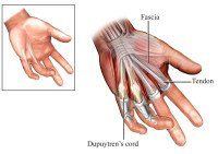 Kleiser Therapy Treats Dupuytrens Contracture