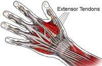 Kleiser Therapy Treats Extensor Tendon Repairs and Lacerations