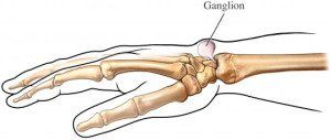 Kleiser Therapy Treats Ganglion Cysts