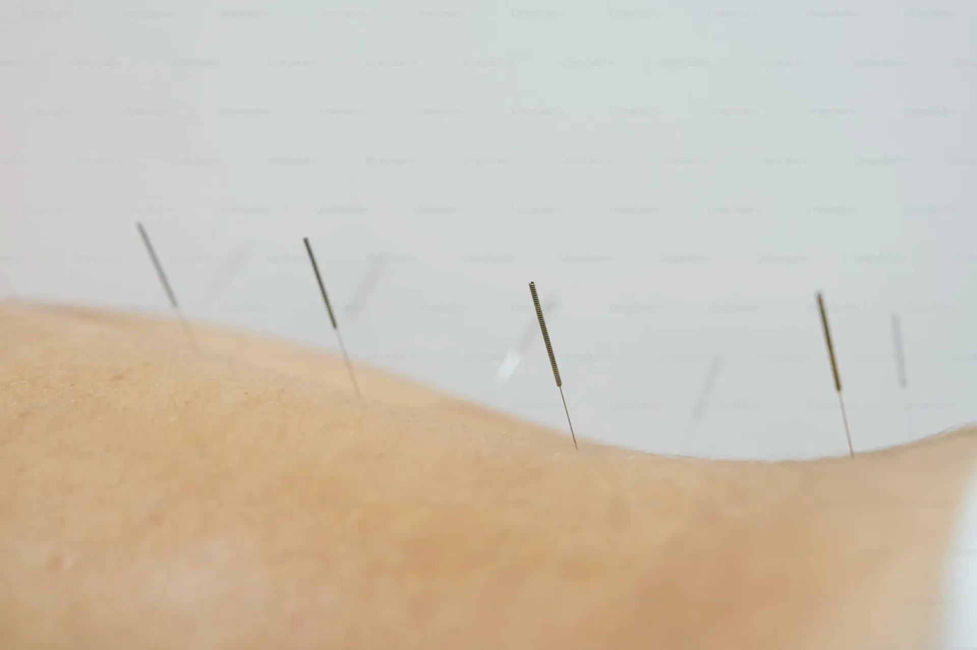 acupuncture