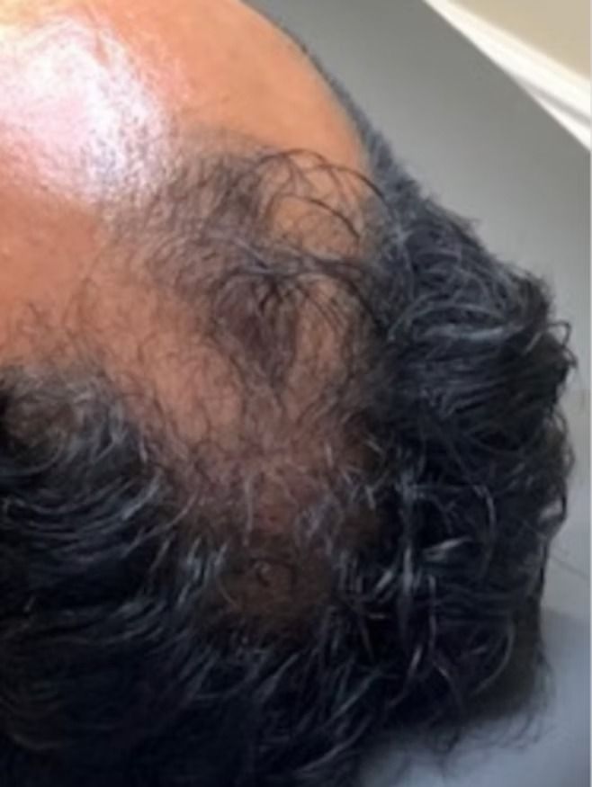 Close-up of a person's scalp showing thinning hair on the crown area, with dark, wavy hair.