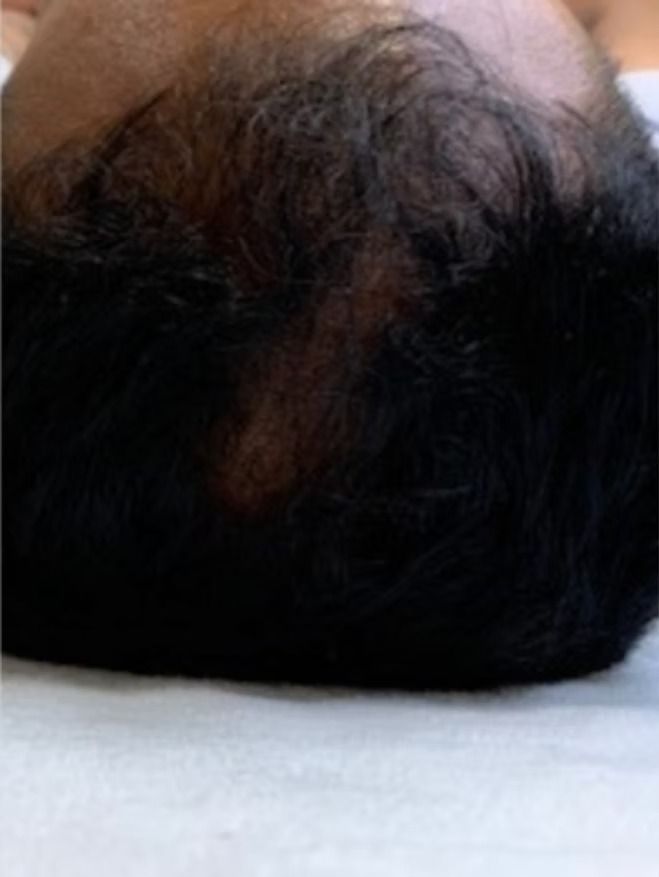 Dark hair on a person's head, partially covering a lighter patch.
