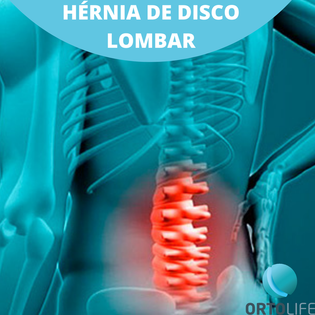 Hérnia de Disco Lombar