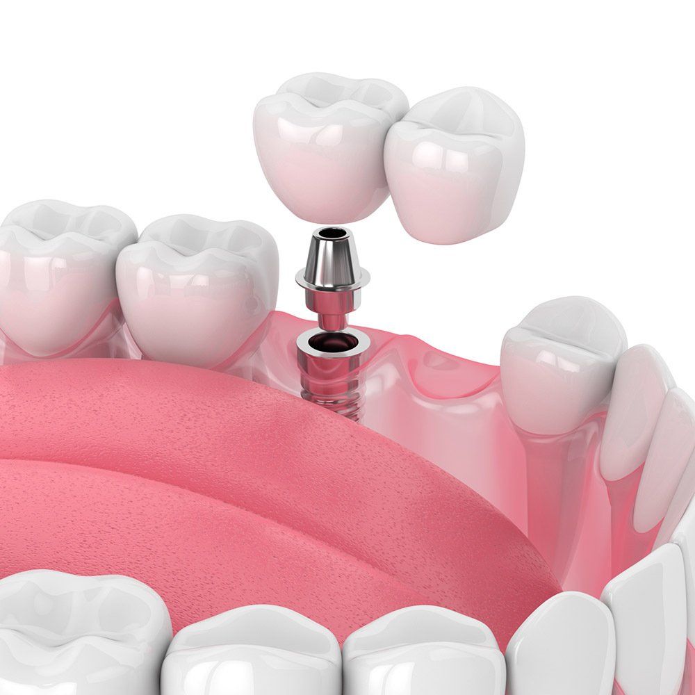 3D image Of Dental Bridges — Hollywood, SA — Norwood & Kensington Dental