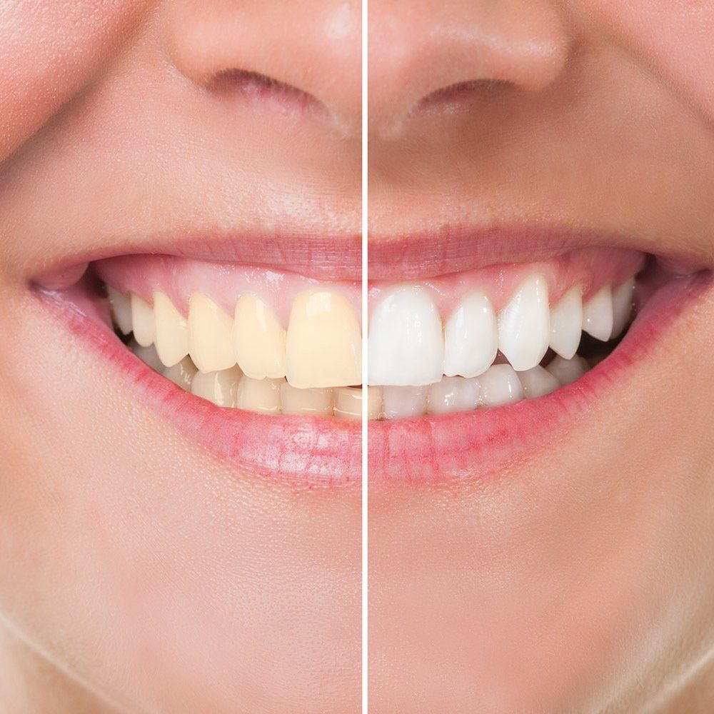 Before And After Teeth Whitening — Hollywood, SA — Norwood & Kensington Dental
