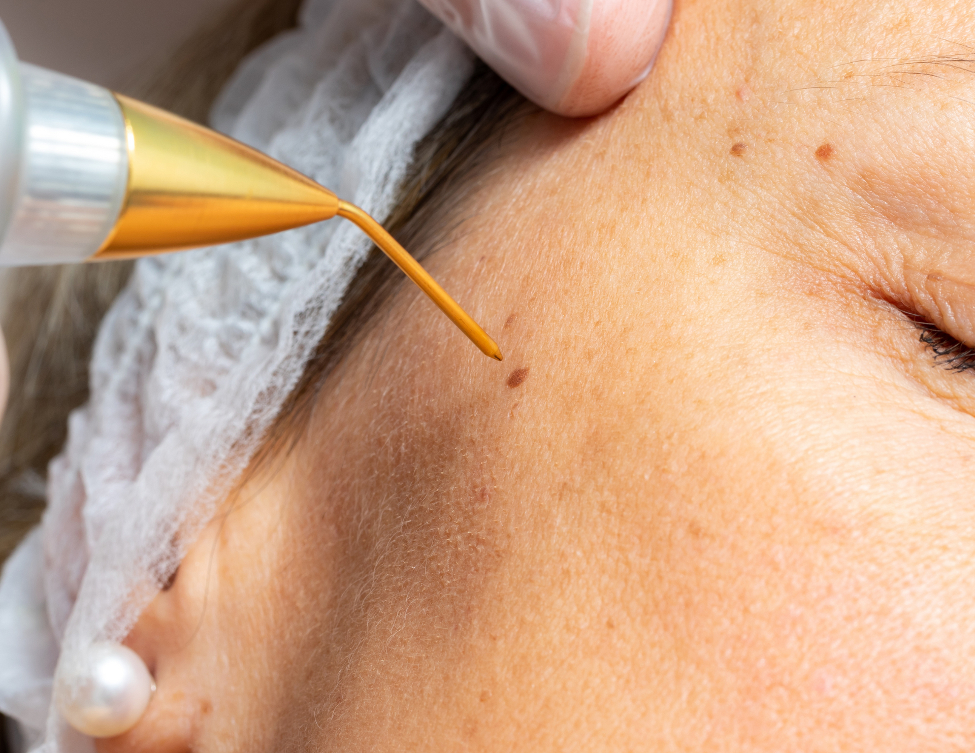 electrocauterizatfioin for seborrheic keratosis, angioma, benign skin lesions