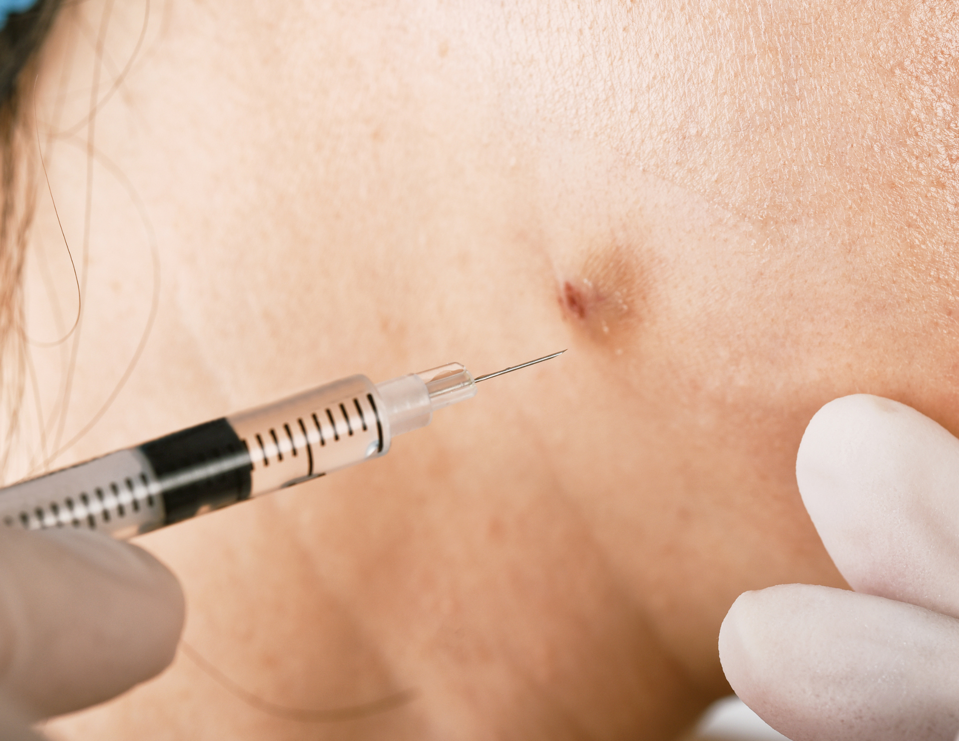 Kenalog Injections, Natural Skin Health