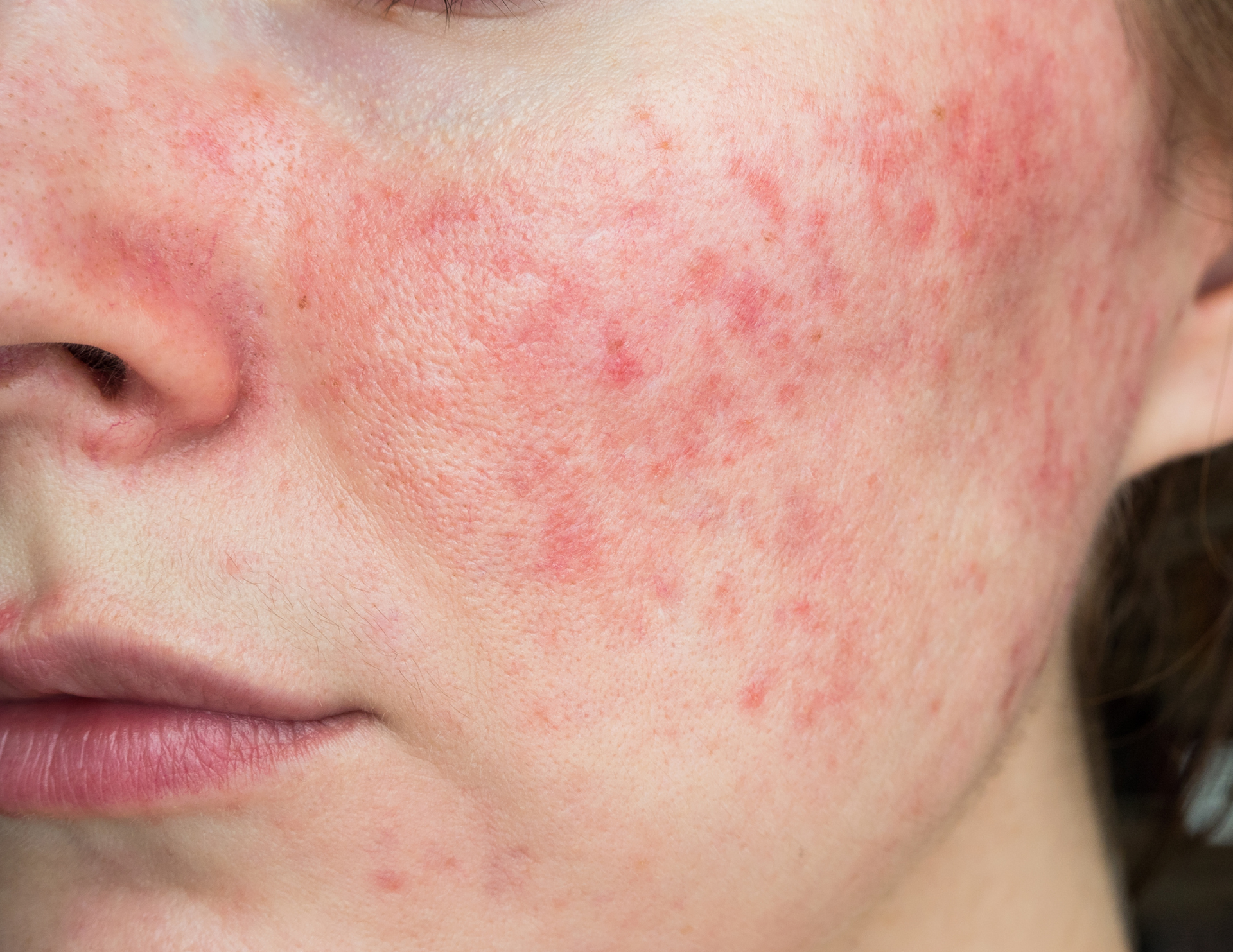 Rosacea Facial