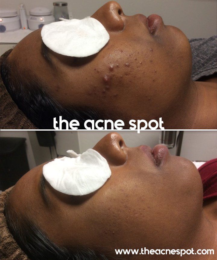 acne spot before & after