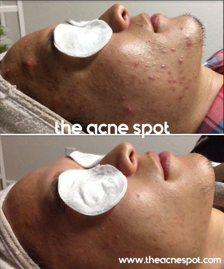 acne spot before & after
