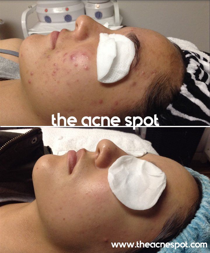 acne spot before & after