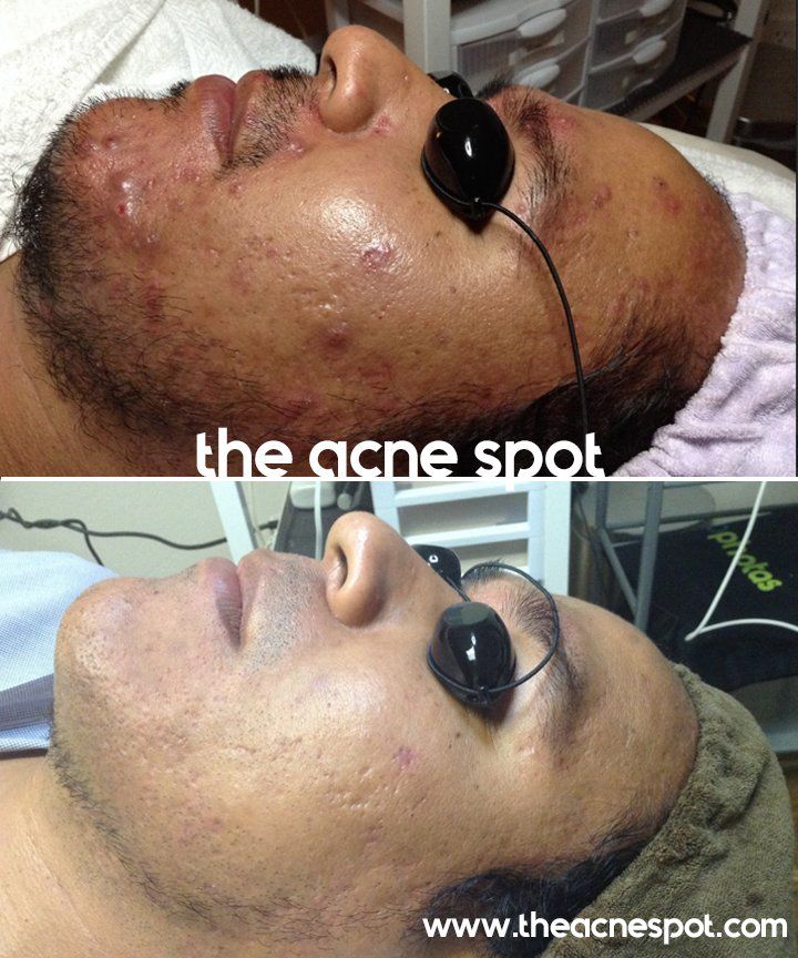 acne spot before & after