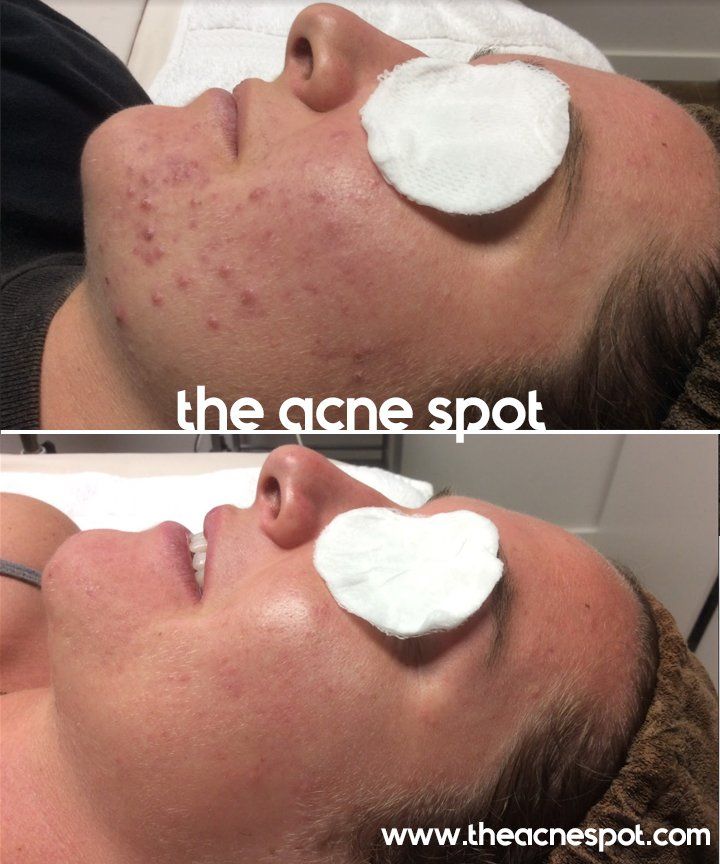 acne spot before & after