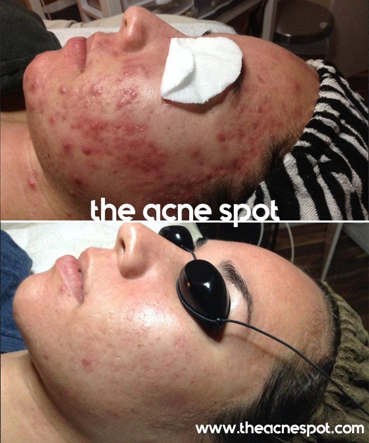 acne spot before & after