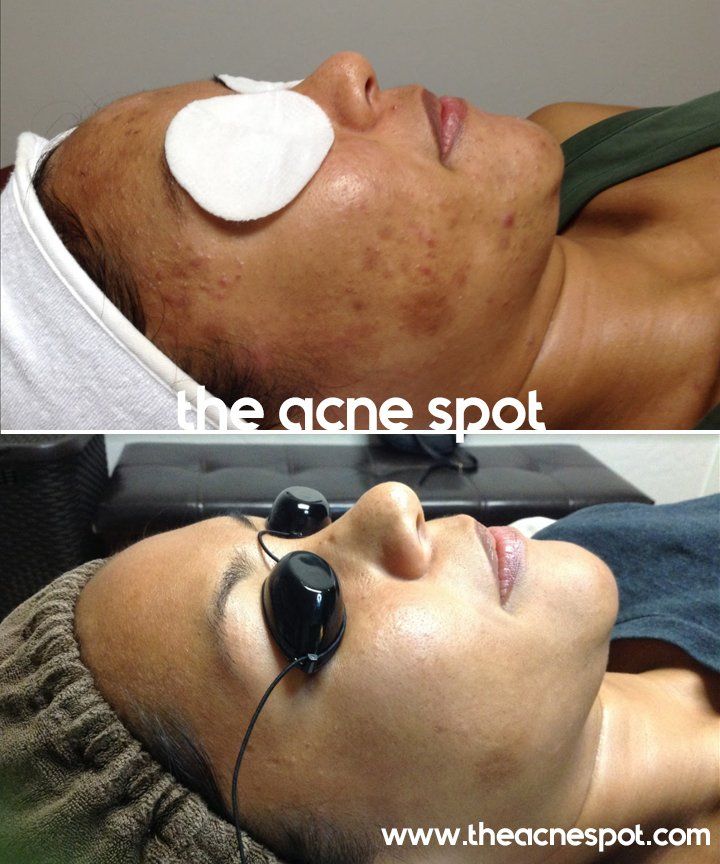 acne spot before & after