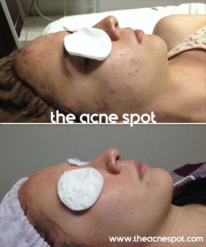 acne spot before & after