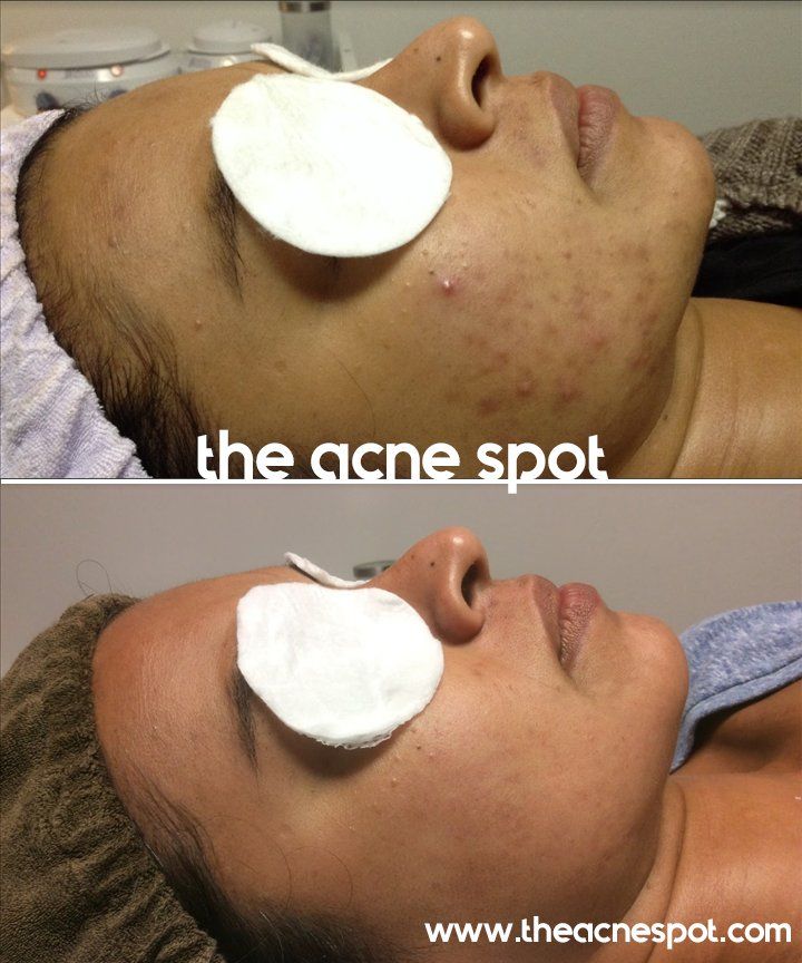 acne spot before & after