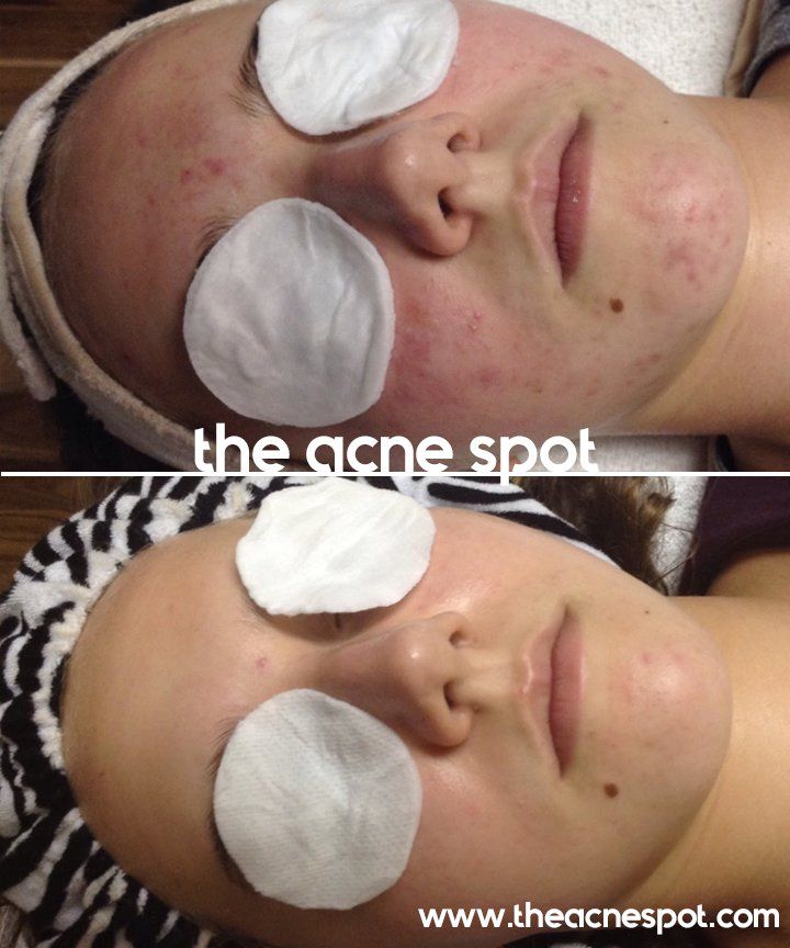acne spot before & after