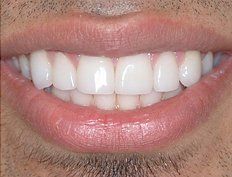 Picture of patient after dental bonding in Jersey City