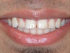 Picture of patient before dental bonding in Jersey City, NJ