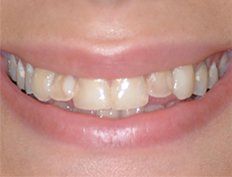 Patient before dental veneers in Jersey City, NJ