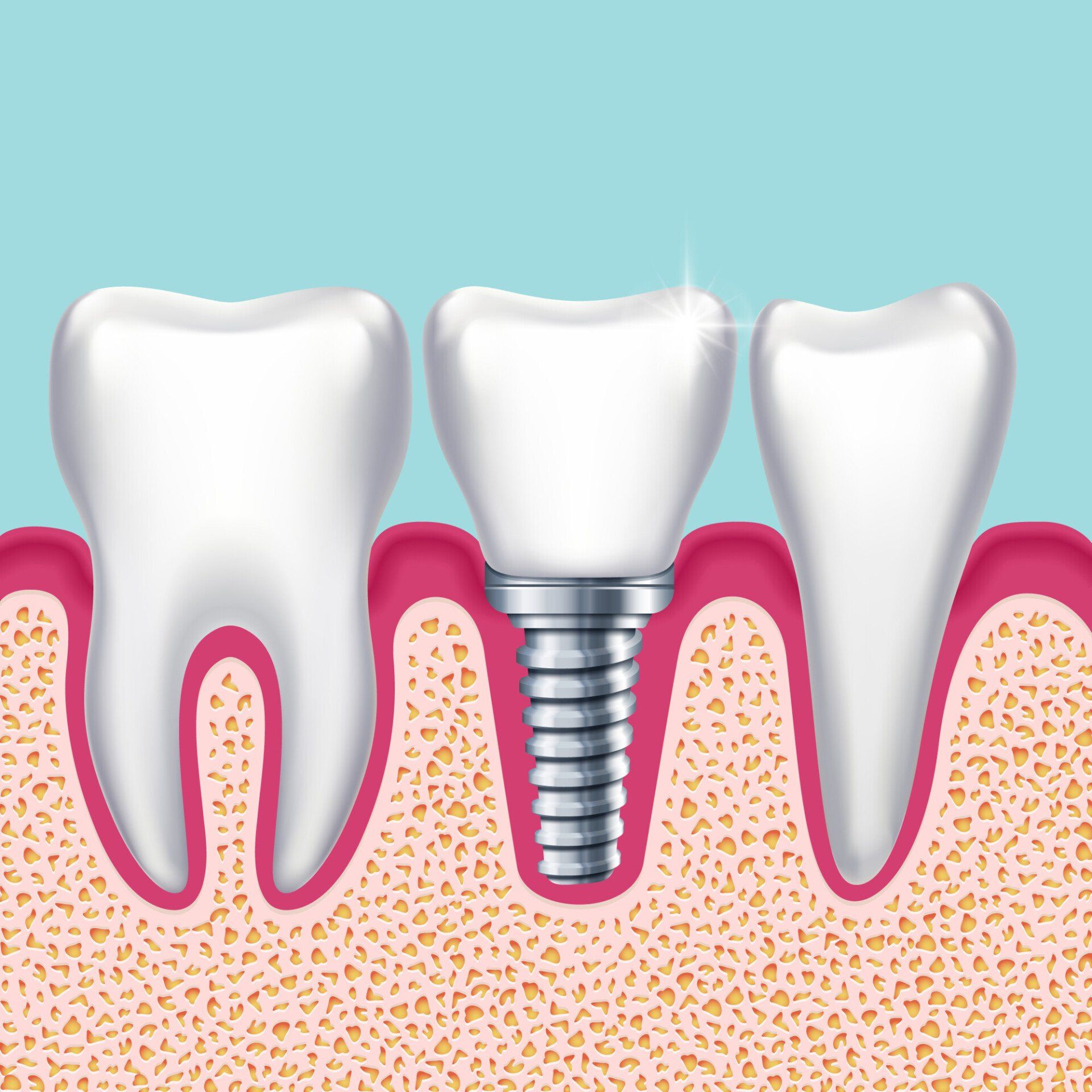What to Consider Before Getting Dental Implants