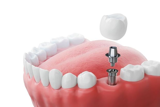 A model of a dental implant with a crown attached to it.