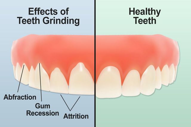 Teeth Grinding (Bruxism)