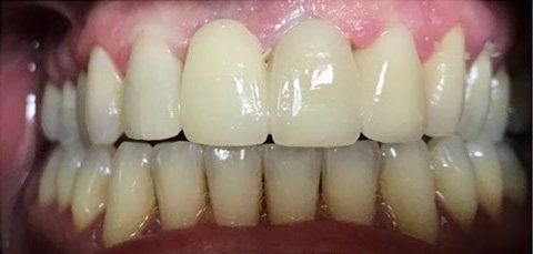 Close-up of a person's teeth; the top four teeth are noticeably whiter than the rest.