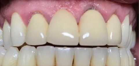 Close-up of teeth, showing dental crowns, in good condition with healthy gums.
