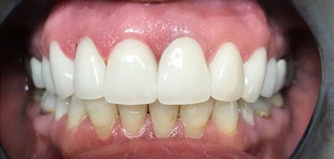 Close-up view of a person's teeth; the upper teeth are white and the lower teeth are yellow.