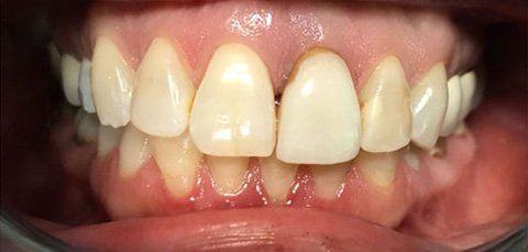 Close-up of a person's teeth showing uneven coloration and spacing.