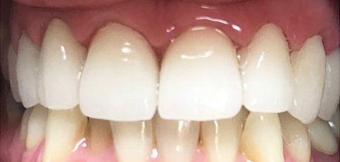 Close-up of a person's teeth. White teeth with a hint of yellow at the base, surrounded by pink gums.