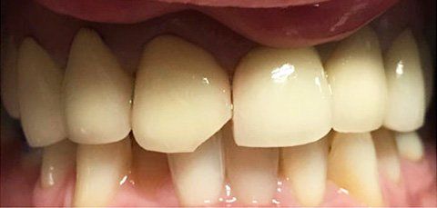 Close-up of a person's teeth, showing a chipped front tooth and other white, healthy teeth.