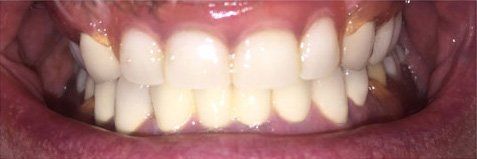 Close-up of human teeth, showing the upper and lower sets, white with yellow at the edges and surrounded by pink gums.