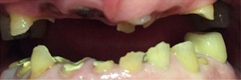 Close-up of open mouth with stained teeth and missing teeth in a dark setting.