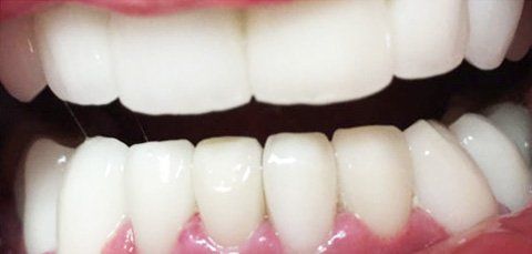 Close-up of a mouth with bright white, straight teeth. Pink gums are visible.