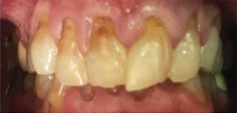 Close-up of teeth, showing yellowed enamel and potential decay.