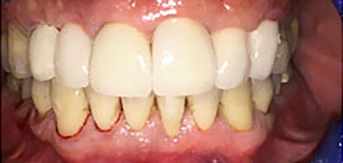 Close-up of human teeth; upper teeth are white, lower teeth are yellow with red outlines.