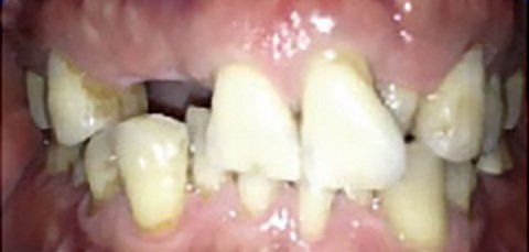 Close-up of a person's teeth. The teeth are discolored and crooked.