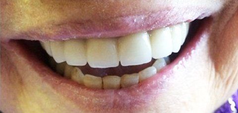 Close-up of a smiling person's teeth, showing white, even upper teeth and some lower teeth.