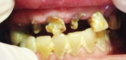 Close-up of severely decayed teeth, with exposed roots and discoloration, inside a person's mouth.