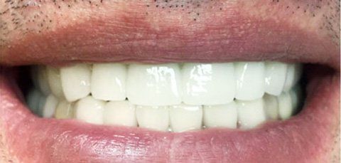 Close-up of a person's smiling mouth showing bright white, even teeth. Dark stubble visible above the lip.